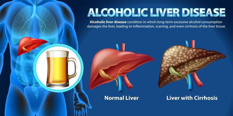 Understanding the Causes and Symptoms of Liver Disease: A Comprehensive Guide - Flash